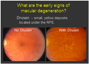 Early signs of Macular Degeneration
