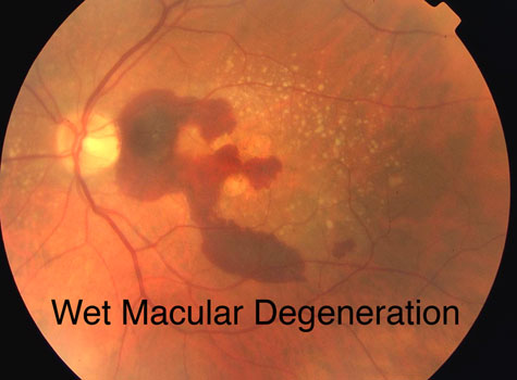 Wet Macular Degeneration