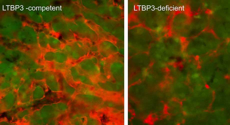 Left: The robust network of fully dilated, angiogenic blood vessels (red) within a primary tumor, which developed from LTBP3-competent epidermoid carcinoma cells (green). Right: In contrast, the LTBP3-deficient tumors develop thinner, collapsed vessels, which are incapable of efficiently supporting cancer cell dissemination. (Image courtesy Elena Deryugina and James P. Quigley. High res version)