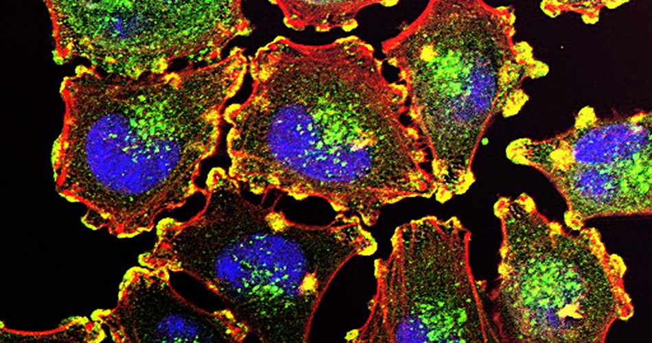 Metastatic melanoma cells. Credit: Julio C. Valencia, NCI Center for Cancer Research