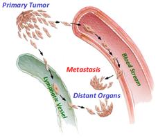 Diagram of breast cancer metastasis