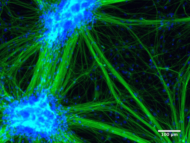 Sensory neurons from Friedreich's Ataxia iPSC cells