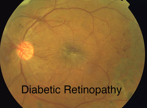 Diabetic Retinopathy