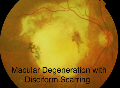 Disciform Scarring