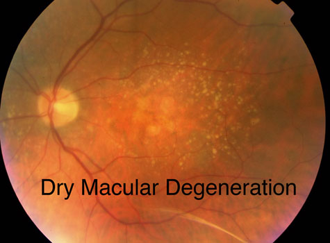 Dry Macular Degeneration