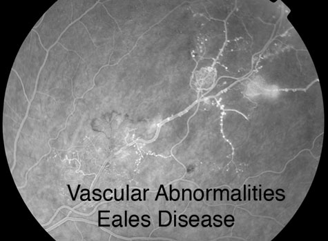 Eales Disease