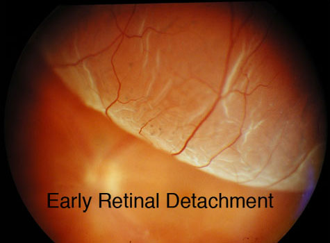 Early Retinal Detachment