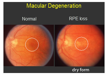 Macular Degeneration RPE Loss