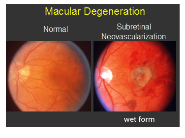 Macular Degeneration