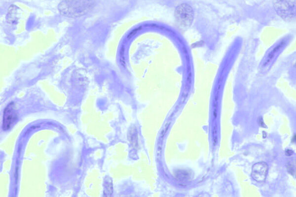 New urine dipstick test detects cause of disease that blinds millions