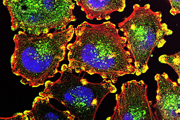 Scientists test new cancer vaccine against melanoma