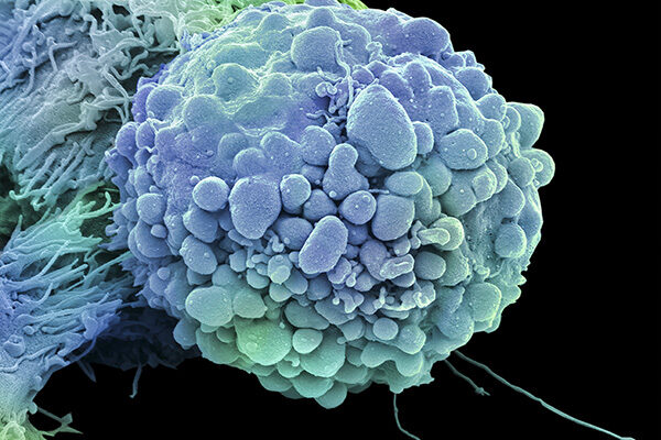 Promising compound selectively kills brain cancer stem cells