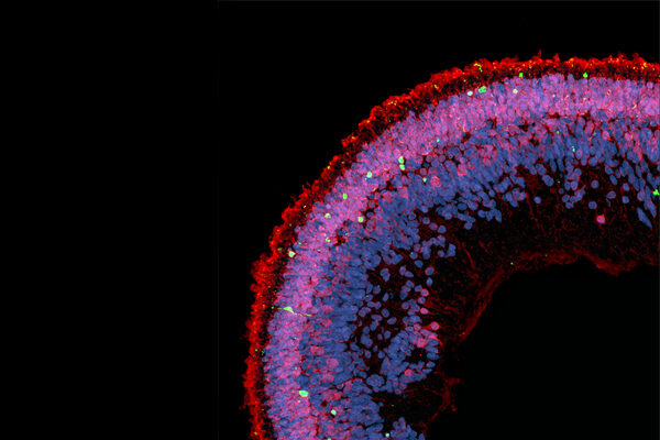 Scientists find cause of debilitating eye disease