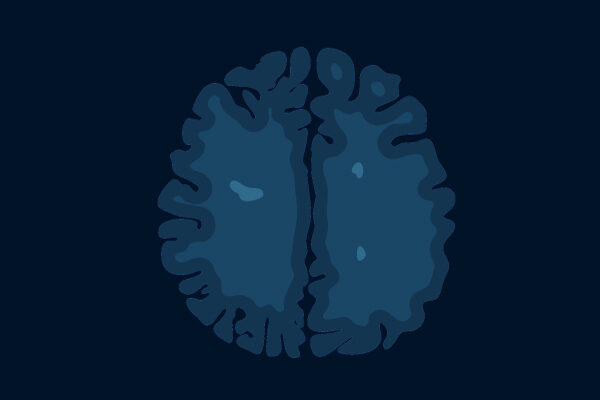 FDA approves ozanimod, a drug invented at Scripps Research, for treatment of multiple sclerosis