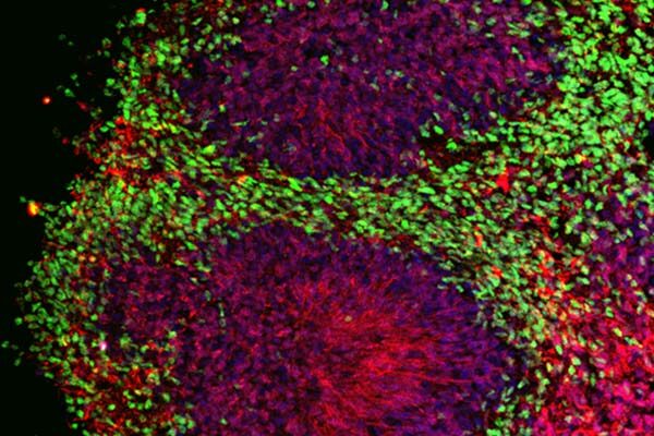 In human mini-brain experiments, drug preserves and rebuilds nerve connections that are lost to Alzheimer’s