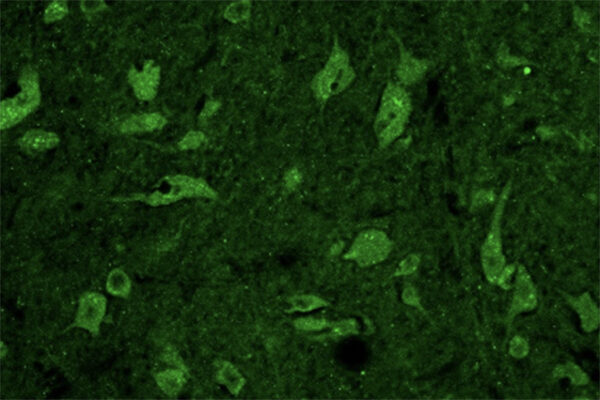 New gene implicated in neuron diseases