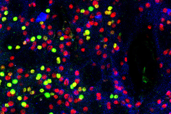 Dangerous side effect of widely used psychiatric drug may be treatable with existing medicine