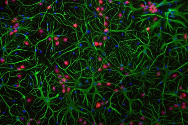 Discovery points to possible new treatment strategy for Parkinson’s disease and Lewy body dementia
