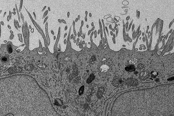 New genetic links found to rare eye disease, opening the door to better diagnostics and potential treatments