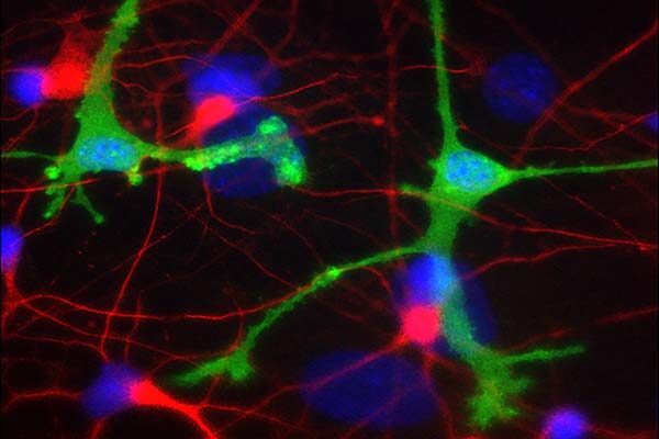 Antibody therapies for Parkinson’s and Alzheimer’s may cause harmful inflammation