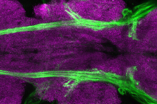 Changes in metabolism may produce neurofibromatosis traits, study finds
