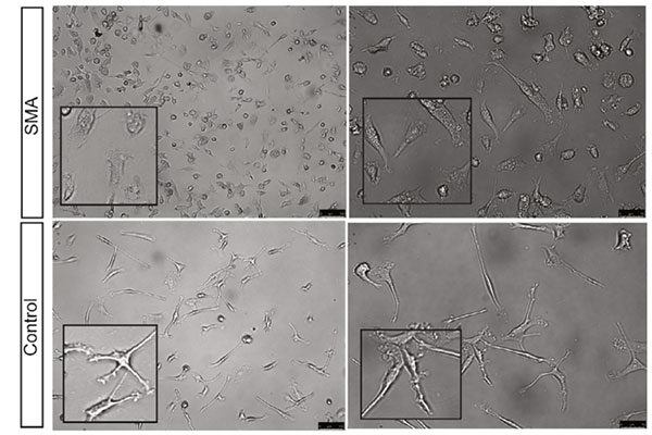 ‘Scavenger’ cells in the nervous system linked to rare genetic disease