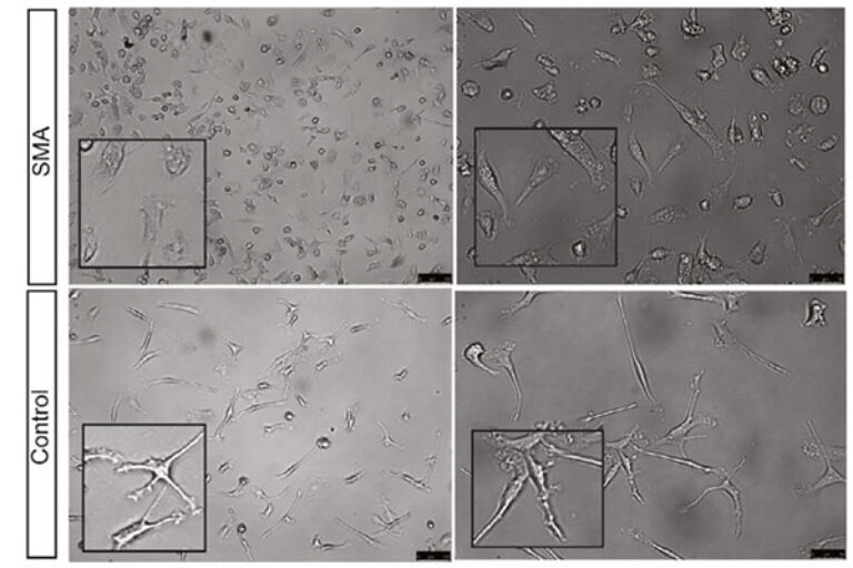 ‘Scavenger’ cells in the nervous system linked to rare genetic disease