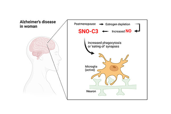 Discovery could explain why women are more likely to get Alzheimer’s
