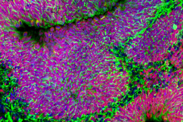“Human mini-brains” reveal autism biology and potential treatments