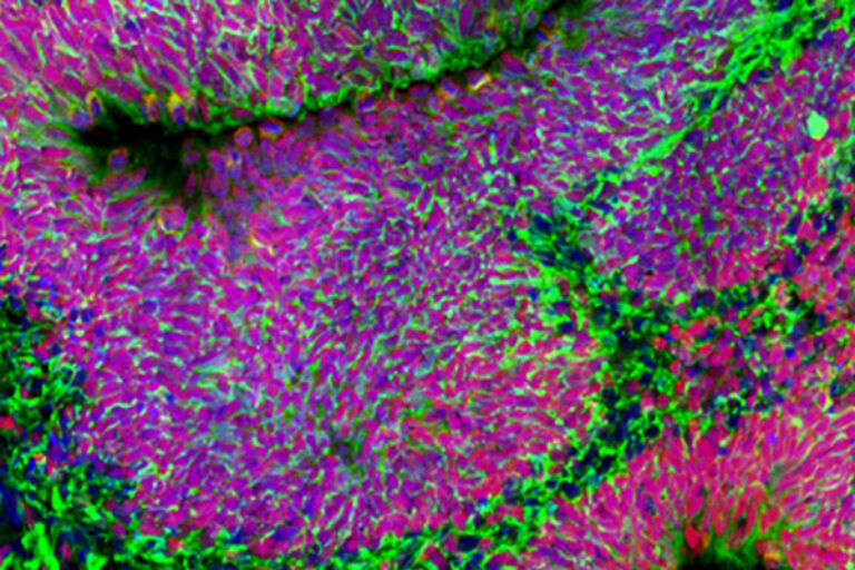 “Human mini-brains” reveal autism biology and potential treatments