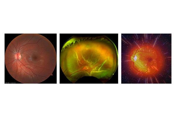 Scripps Research and UC San Diego join national team to make vision-restoring whole eye transplants a reality