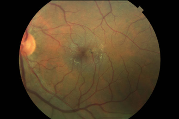 FDA approves ENCELTO, a first-of-its-kind eye implant that slows vision loss in rare eye disease