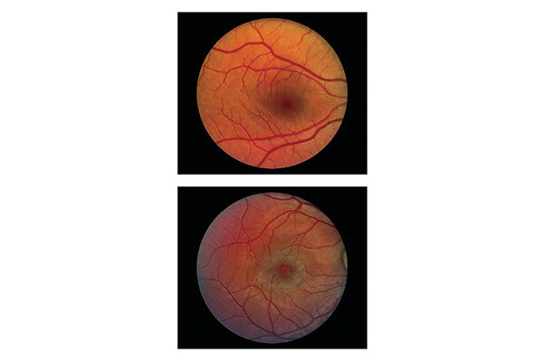 Study confirms long-term benefit of implant for blinding eye disease
