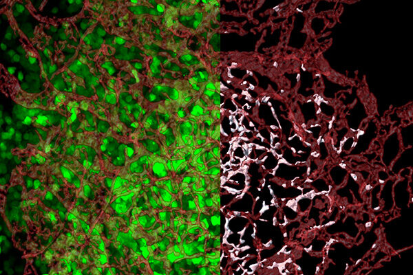 At Last, a Clue to Where Cancer Metastases Are Born