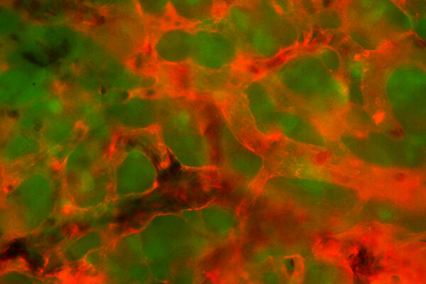 TSRI scientists take big step toward stopping cancer metastasis