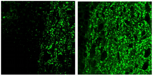 How a chemical reaction triggers brain inflammation in Alzheimer’s disease