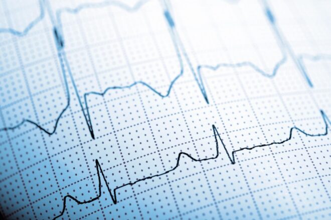 ecg paper